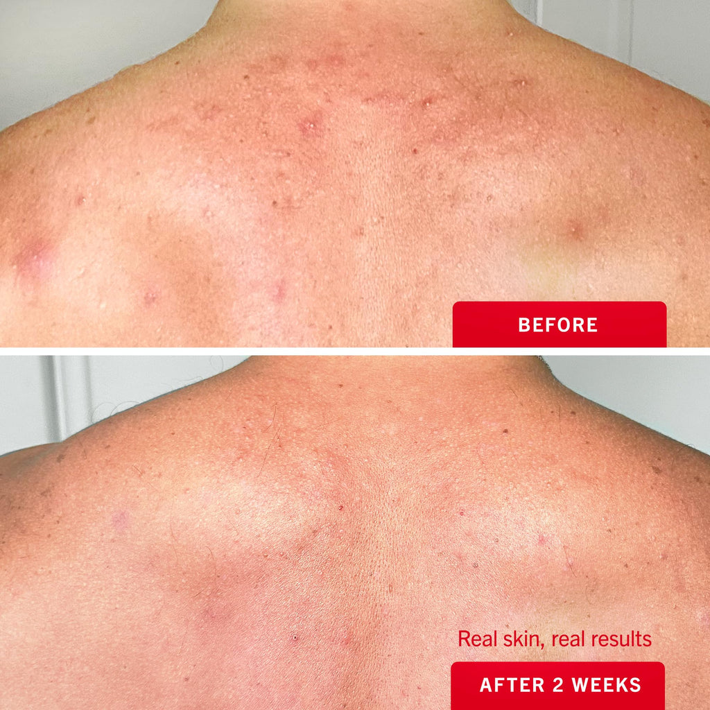 First Aid Beauty Body Acne Spray - Maximum Strength 2% Salicylic Acid, 360° Sprayer, 3 oz