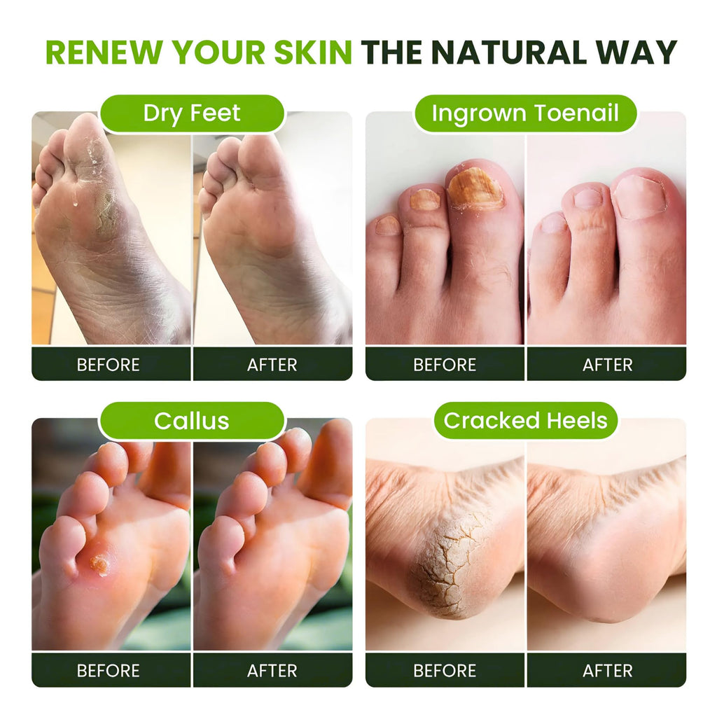 FOOT CURE Tea Tree Oil Foot Soak with Epsom Salts – Pack of 4 for Foot Comfort, Odor & Calluses