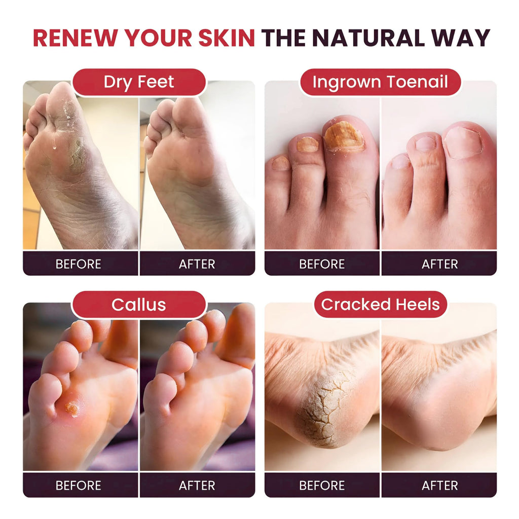 FOOT CURE Tea Tree Oil & Muscle Foot Soak with Epsom Salts – All-Natural Foot Care (Pack of 2)