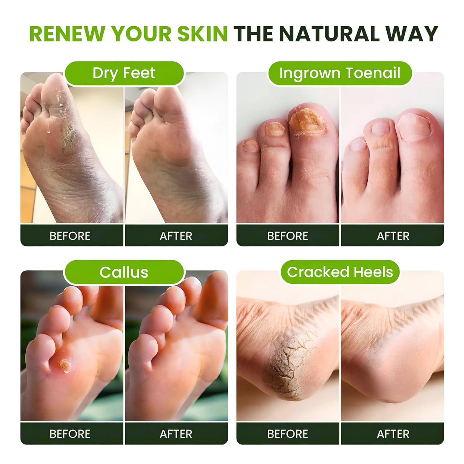 FOOT CURE Tea Tree Oil Foot Soak with Epsom Salts – Pack of 4 for Foot Comfort, Odor & Calluses