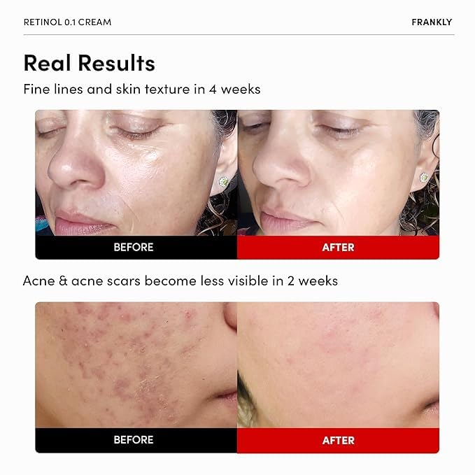 FRANKLY Retinol 0.1% Cream – Beginner Night Cream with Ceramides & Ginseng