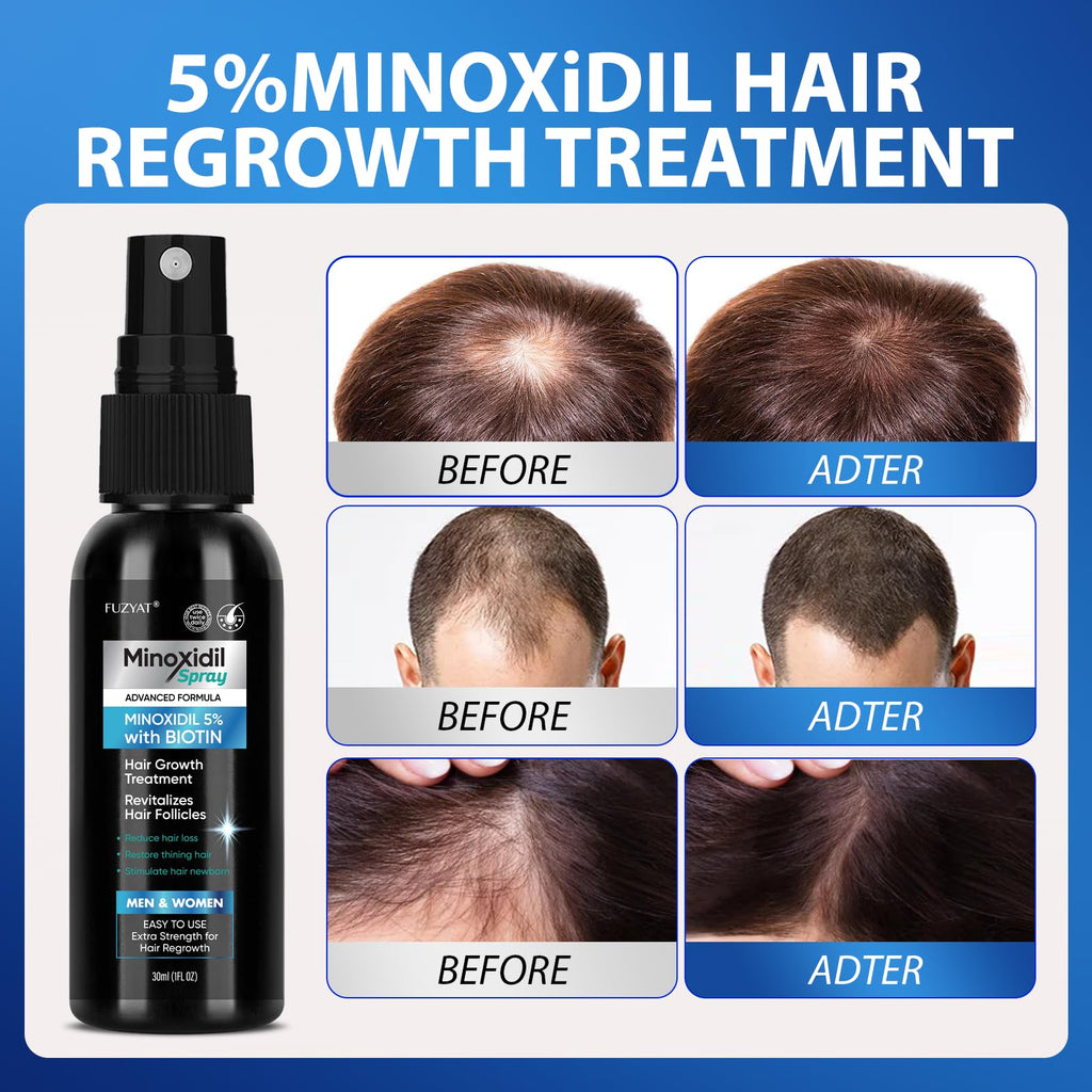 FUZYAT 5% Minoxidil Spray – Biotin-Enhanced Hair Growth for Men & Women, 180ml