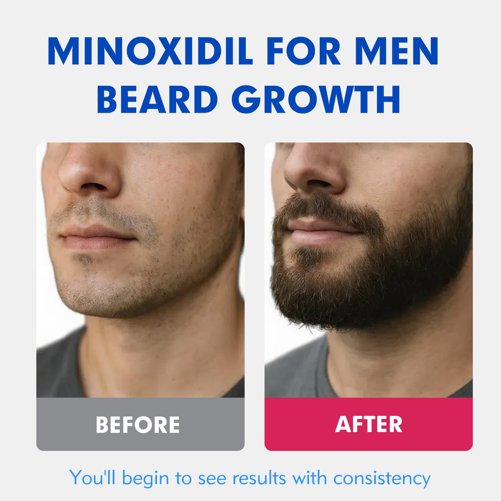Fyntikal 5% Minoxidil for Men – Extra-Strength Hair Regrowth Topical Solution (4-Month Supply)