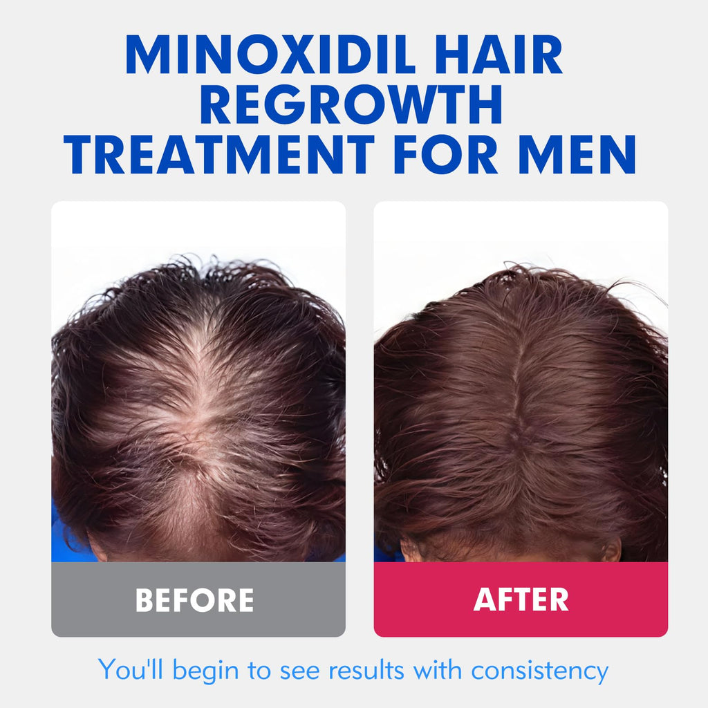 Fyntikal 5% Minoxidil for Men – Extra-Strength Hair Regrowth Topical Solution (4-Month Supply)