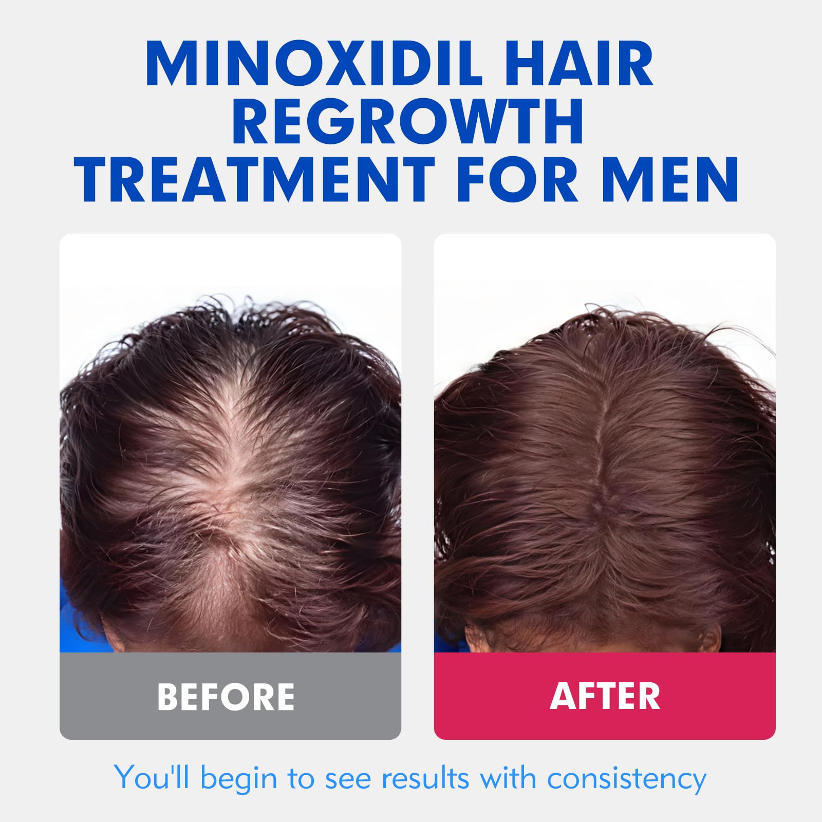 Fyntikal 5% Minoxidil for Men – Extra-Strength Hair Regrowth Topical Solution (4-Month Supply)