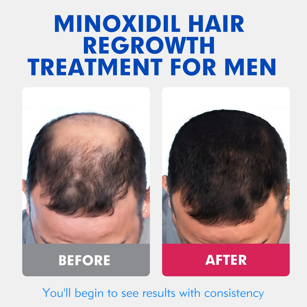Fyntikal 5% Minoxidil for Men – Extra-Strength Hair Regrowth Topical Solution (4-Month Supply)