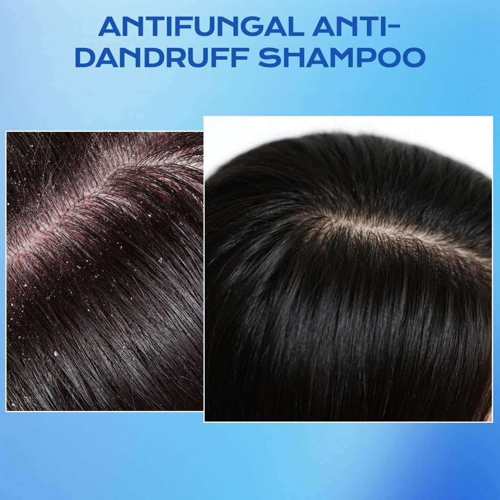 FYZMTL Anti-Dandruff Shampoo for Folliculitis & Scalp Psoriasis | Flake Control & Itch Relief
