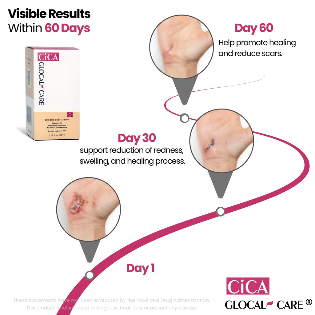 GlocalCare CICA Scar Cream – Silicone Scar Treatment for New & Old Scars, PIH & Stretch Marks (50 ml)