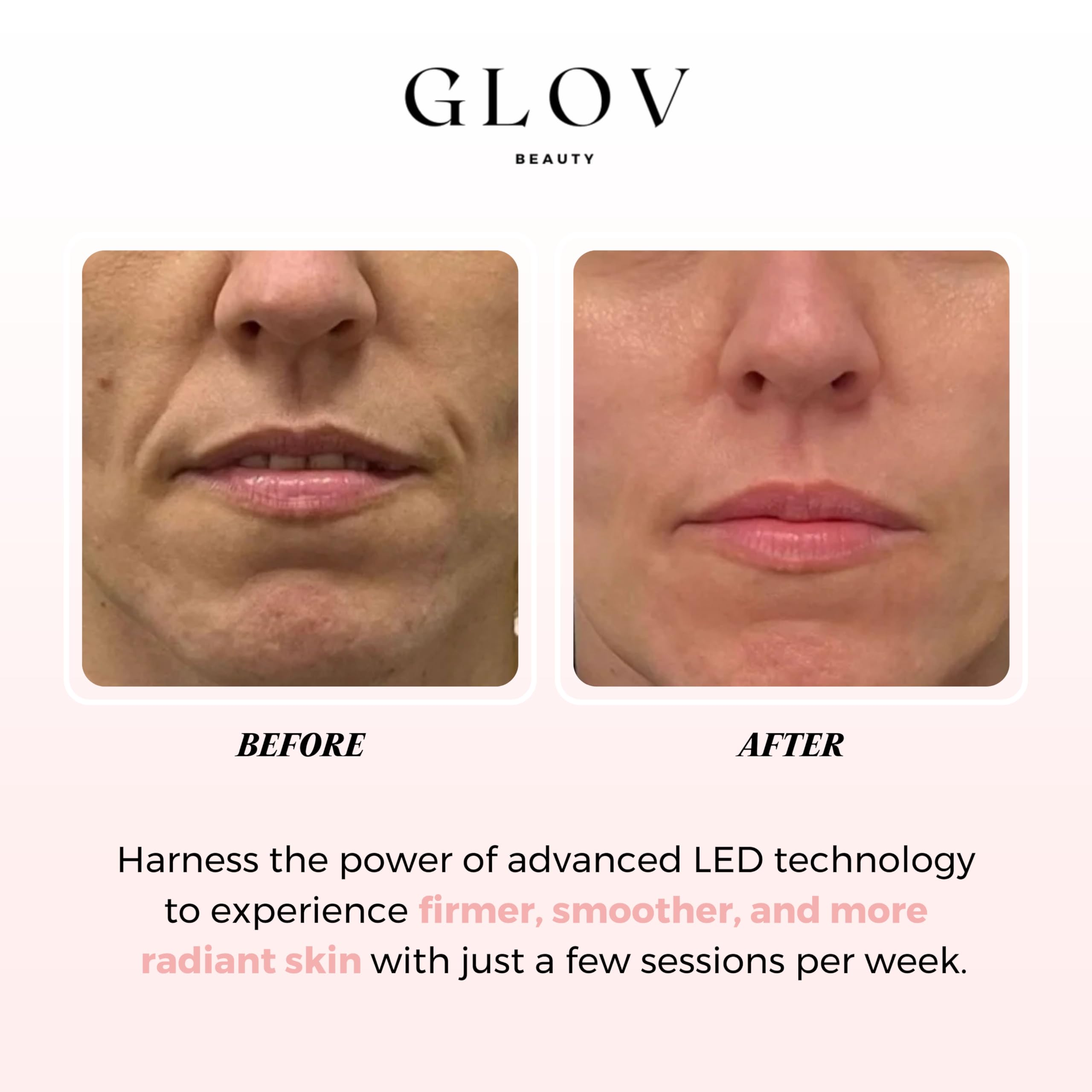 Glov Beauty LED Face Mask – Red Light Therapy for Firmer, Smoother Skin
