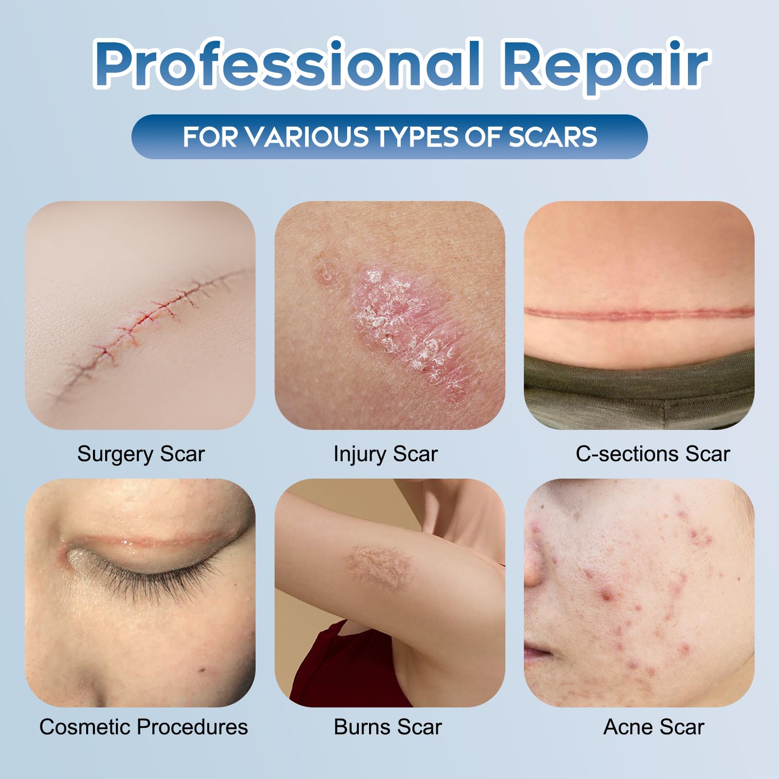 Glowor Advanced Silicone Scar Gel for Face & Body – Scar Cream for Old & New Scars