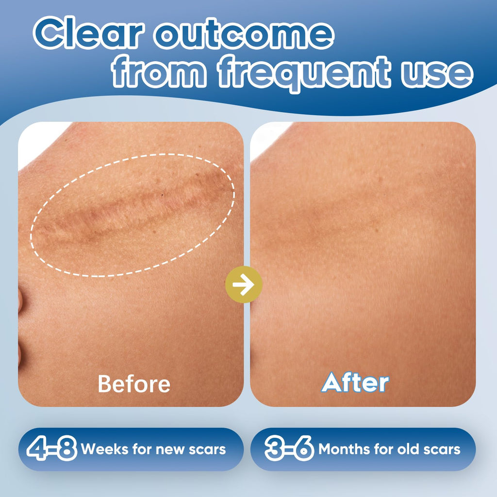 Glowor Advanced Silicone Scar Gel for Face & Body – Scar Cream for Old & New Scars