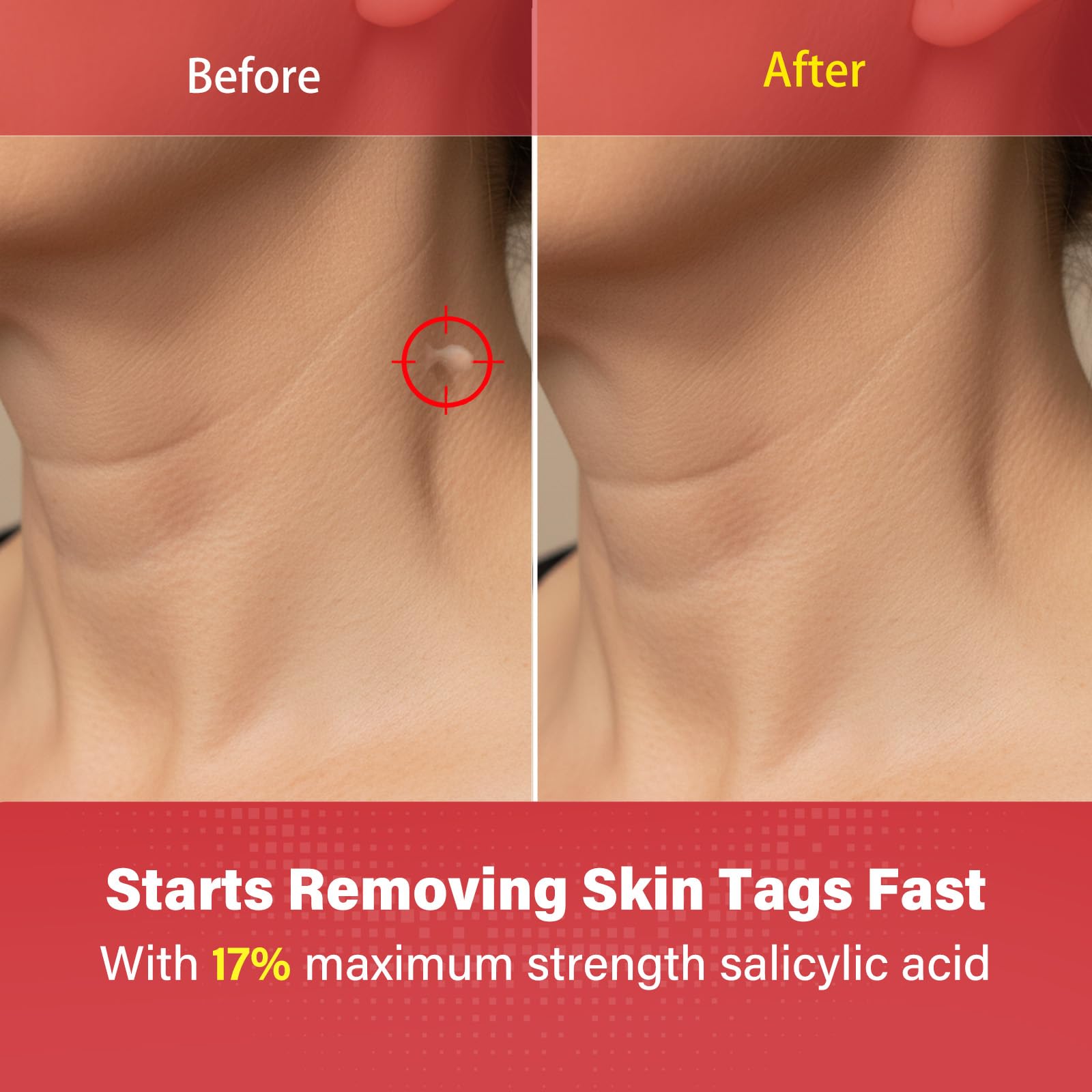 Goodnites Skin Tag Remover – Fast-Acting Gentle Salicylic Acid Formula for Neck, Underarms, Groin | 112 PCS