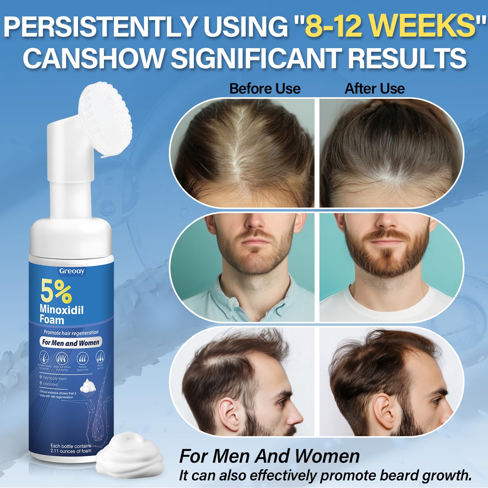 Greoay 5% Minoxidil Hair Growth Foam – 2.11 oz | For Men & Women, Fuller, Thicker Hair