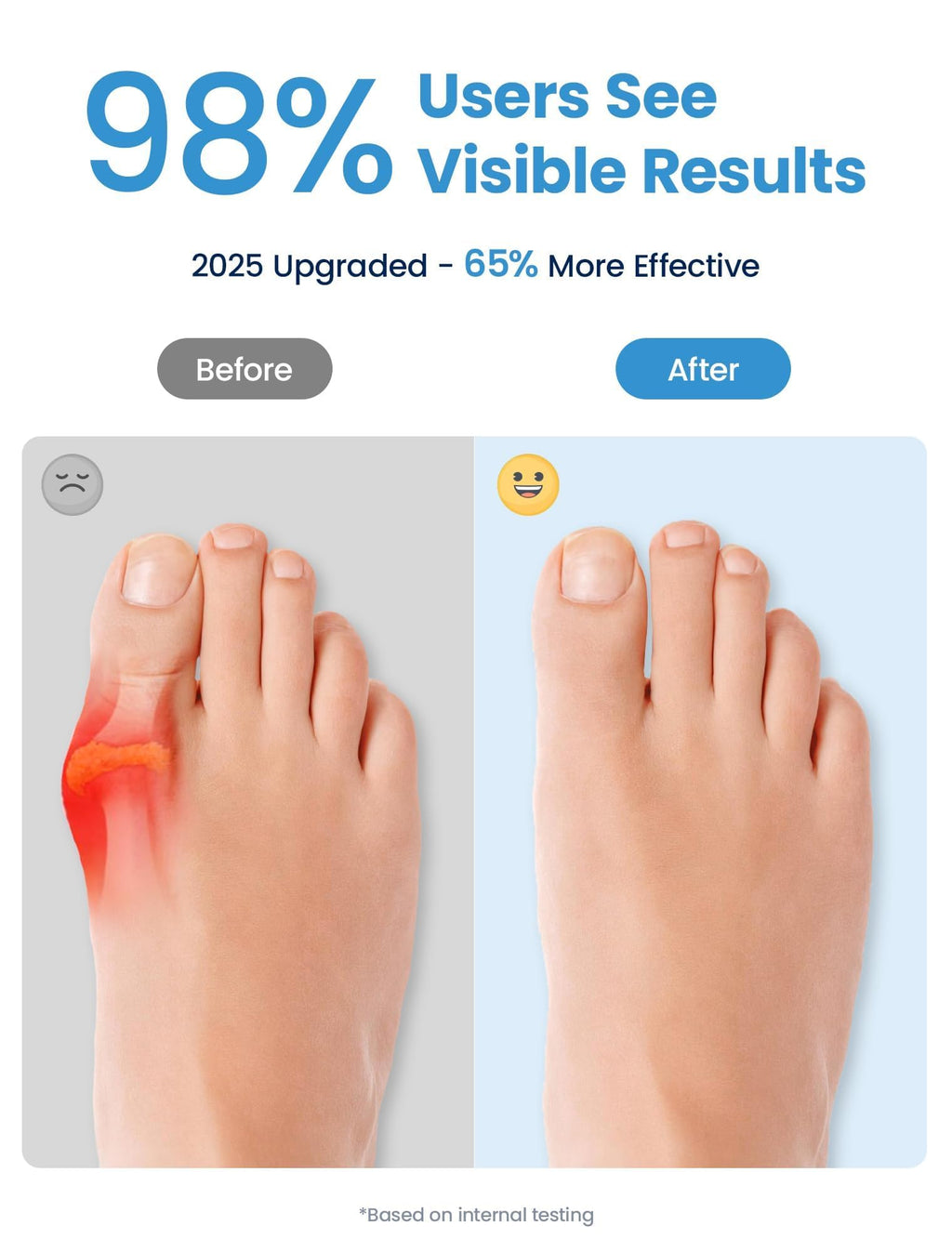 Habioer Bunion Corrector – Breathable Toe Spacers (2-Pack) for Women & Men