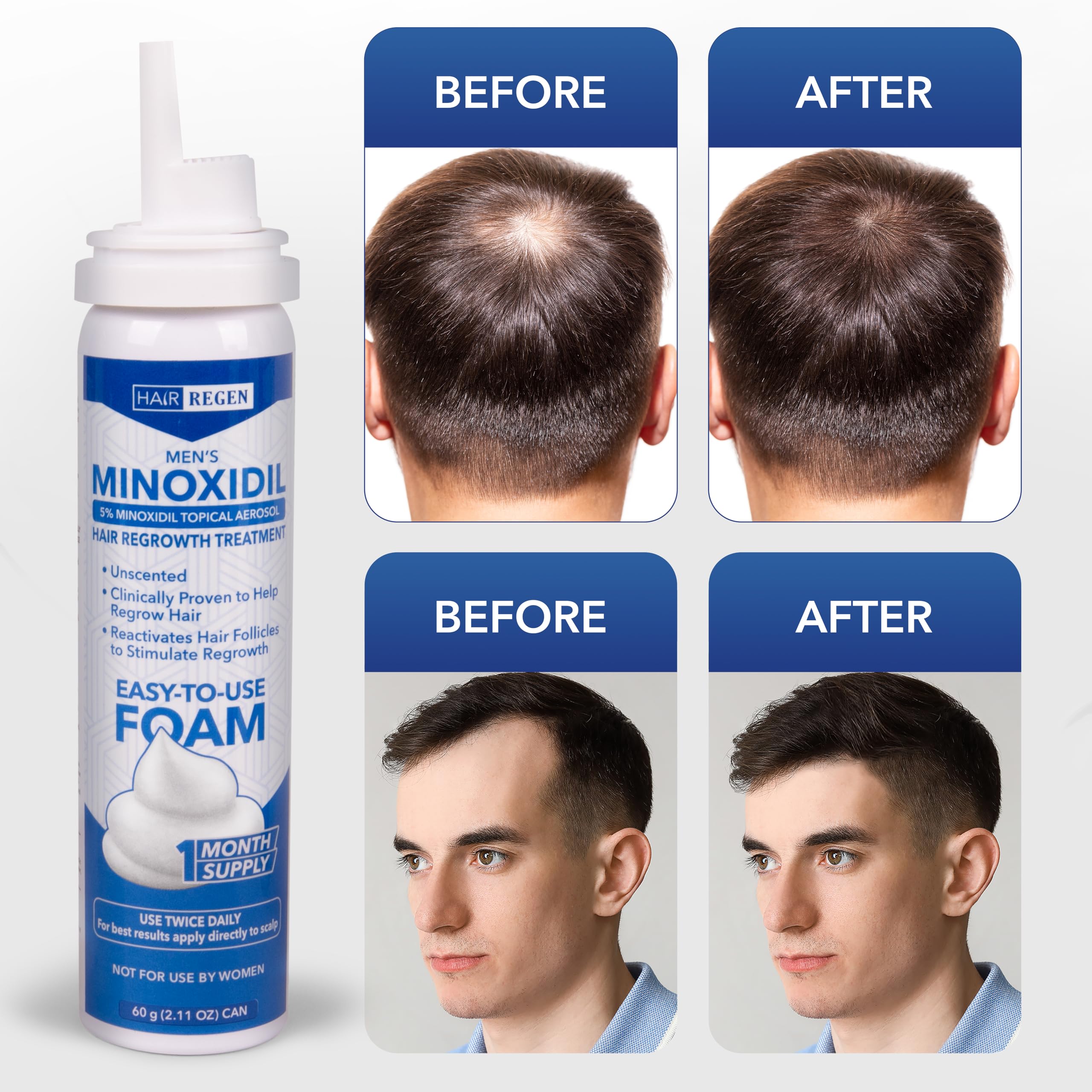 Hair Regen Minoxidil Foam 5% for Men – 6 Pack (6 Months)