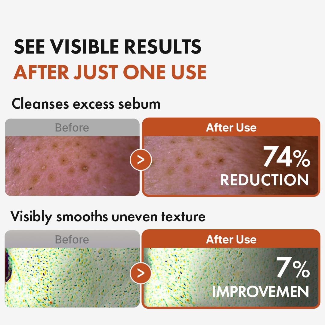 Hanskin BHA Pore Cleansing Oil – Gentle Cleanser for Oily & Combination Skin (10.14 oz)