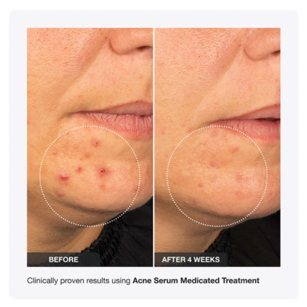 INNBEAUTY Project Acne Serum | Medicated Acne Treatment for Breakouts & Oil Control | 1 oz