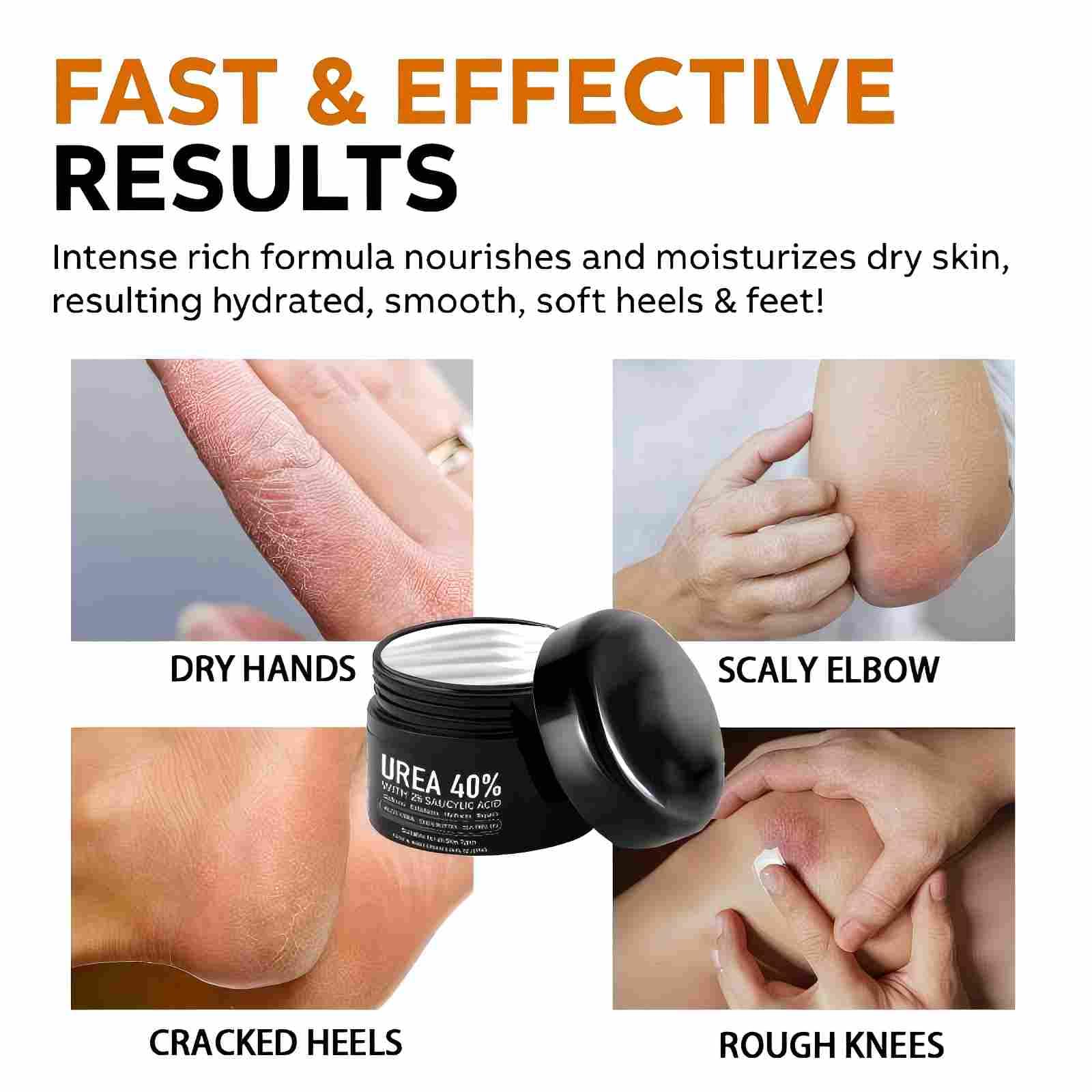 IOIOTCO Urea Cream 40% + 2% Salicylic Acid – Exfoliating Foot & Hand Moisturizer