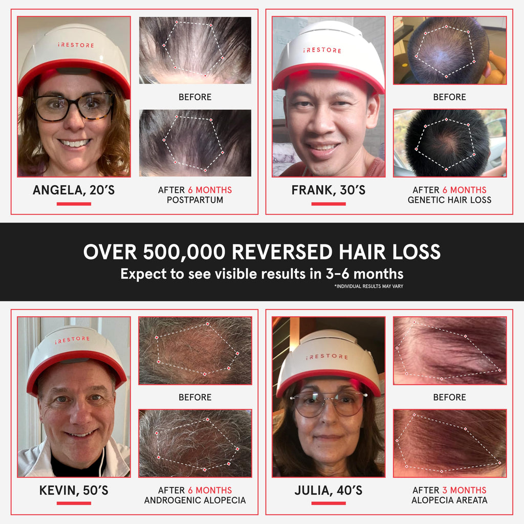 iRestore Pro: 282 Lasers & LEDs Hair Growth System | FDA Cleared