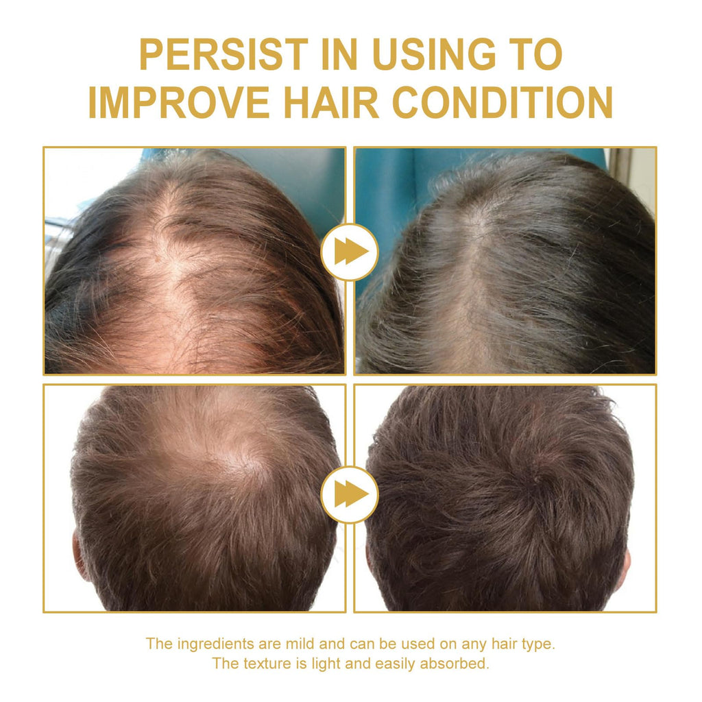 JISKG 180 ml EELHOE Rosemary Hair Growth Oil – 3-Pack for Dry & Damaged Hair