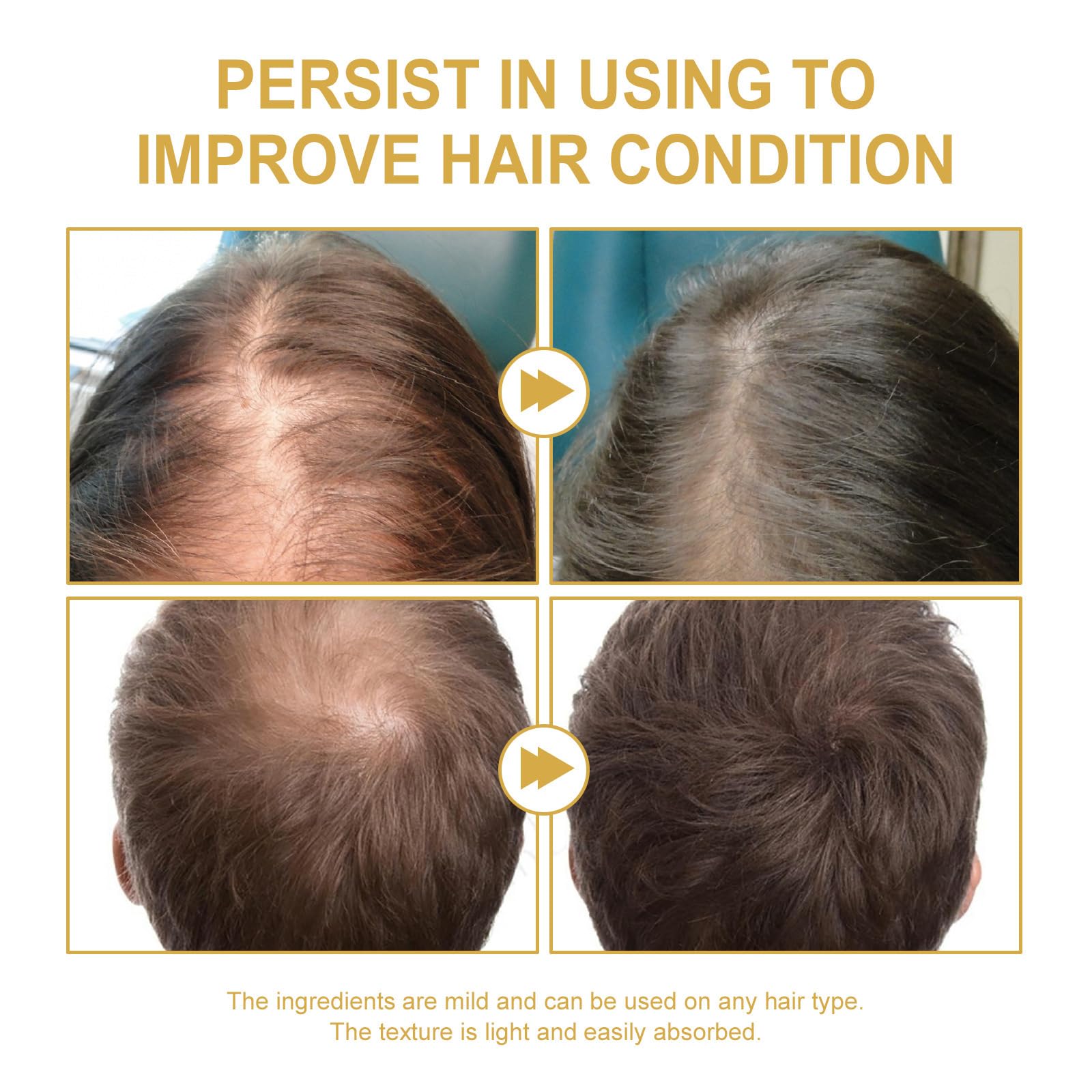 JISKG 180 ml EELHOE Rosemary Hair Growth Oil – 3-Pack for Dry & Damaged Hair