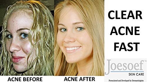 Joesoef Anti-Acne Soap with Volcanic Sulfur 10% — For Oily to Normal Skin | Pack of 3 | JOESOEF SKIN CARE