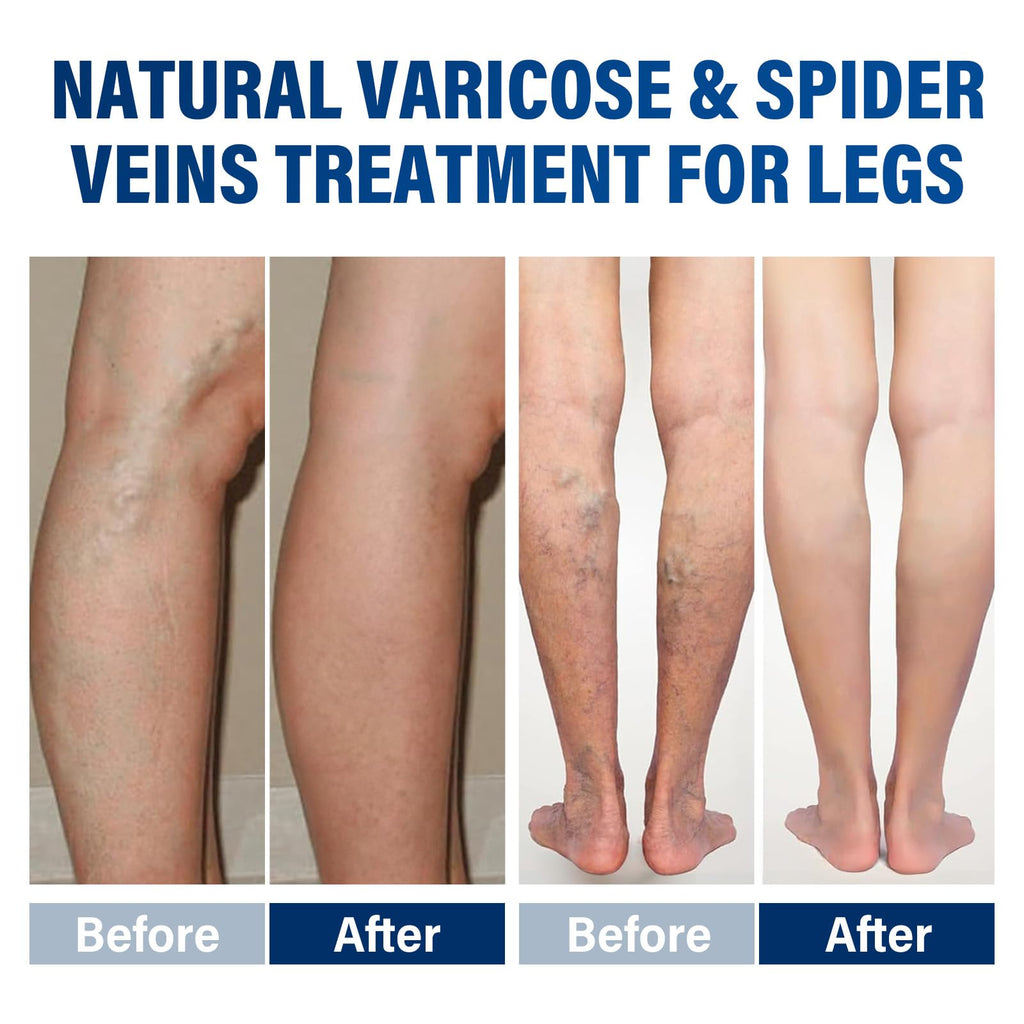 Josera Varicose Veins Cream for Legs – Soothing Relief & Smoother Skin (2 x 20 g)