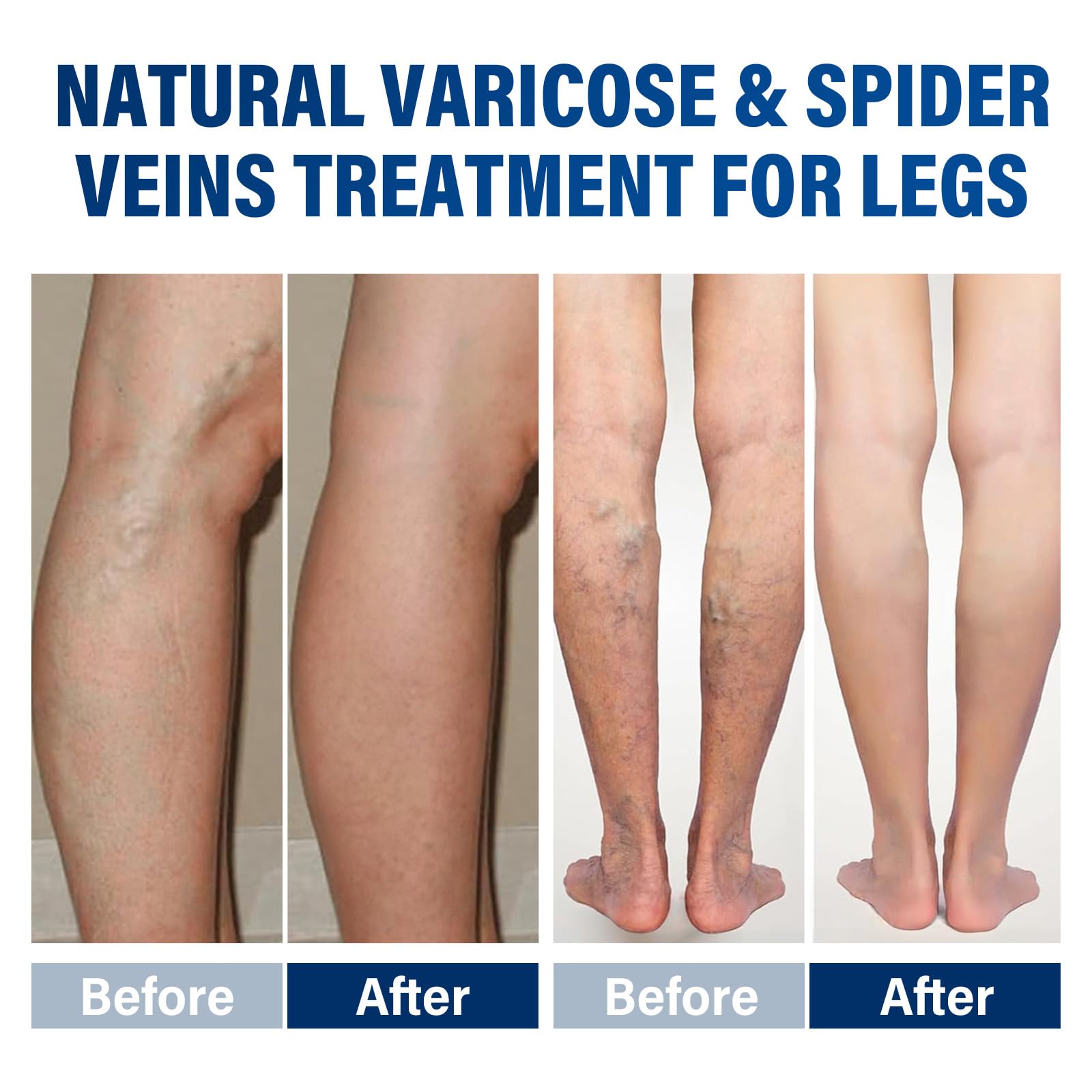 Josera Varicose Veins Cream for Legs – Soothing Relief & Smoother Skin (2 x 20 g)