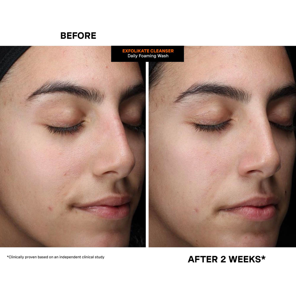 Kate Somerville ExfoliKate Cleanser: Daily Exfoliating Foaming Face Wash with Glycolic & Lactic Acids (8 oz)