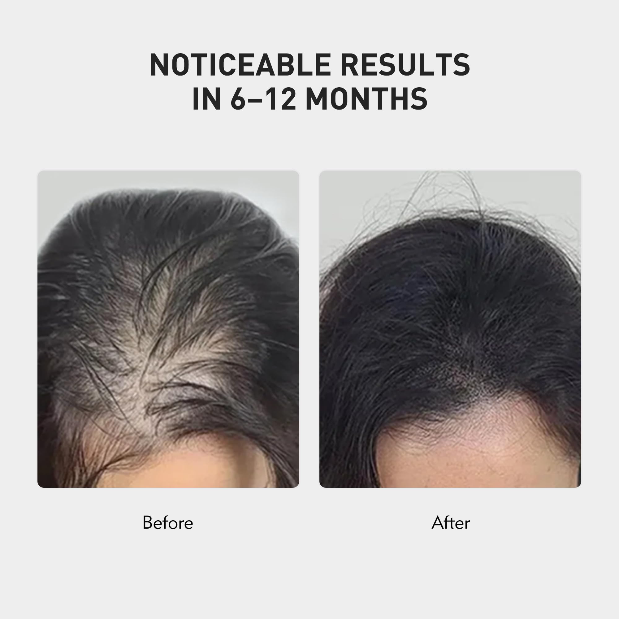 KINTOR 0.9% KX-826 Hair Regrowth Spray – Supports Healthy Hair Growth & Oil Control | 60ml