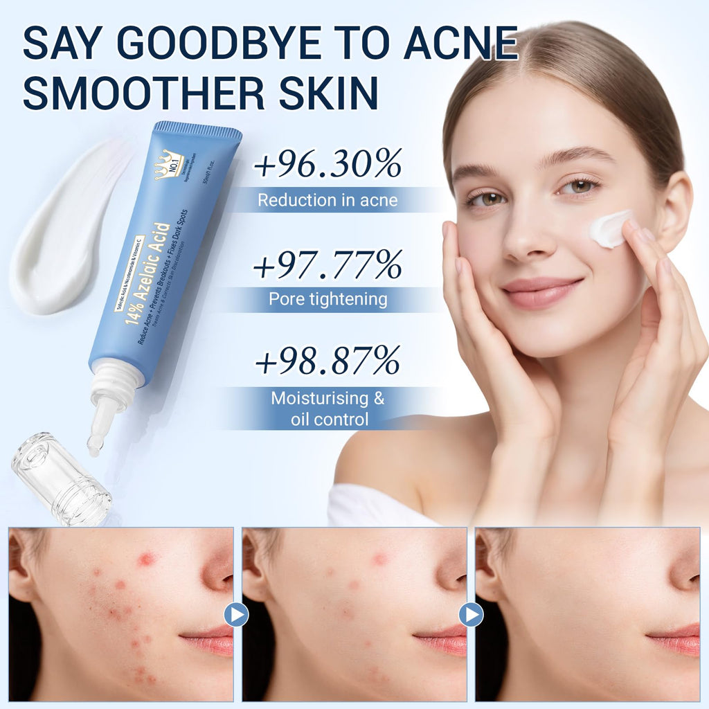 KIUORET 14% Azelaic Acid Acne Cream with Hyaluronic Acid, Niacinamide & Squalane