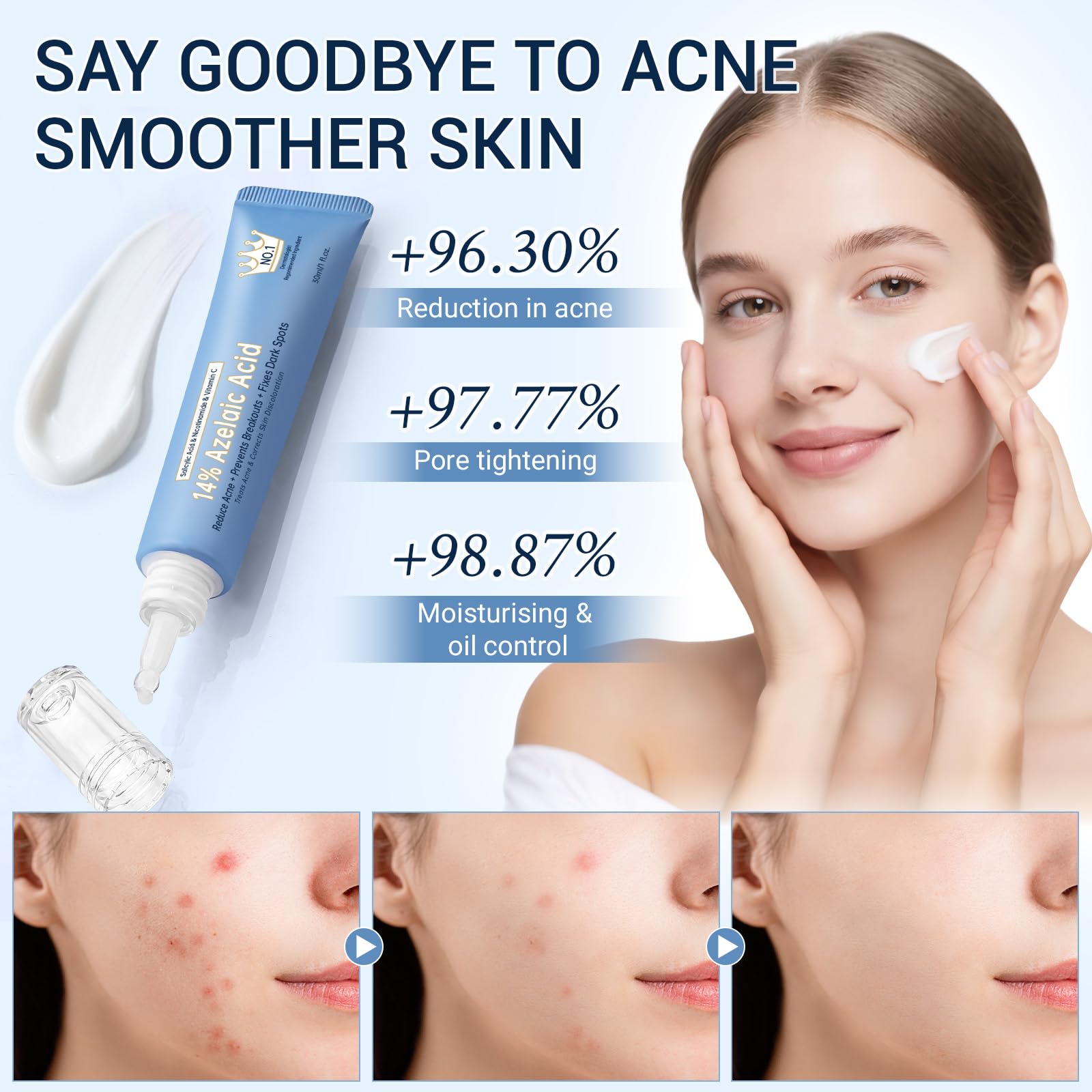 KIUORET 14% Azelaic Acid Acne Cream with Hyaluronic Acid, Niacinamide & Squalane