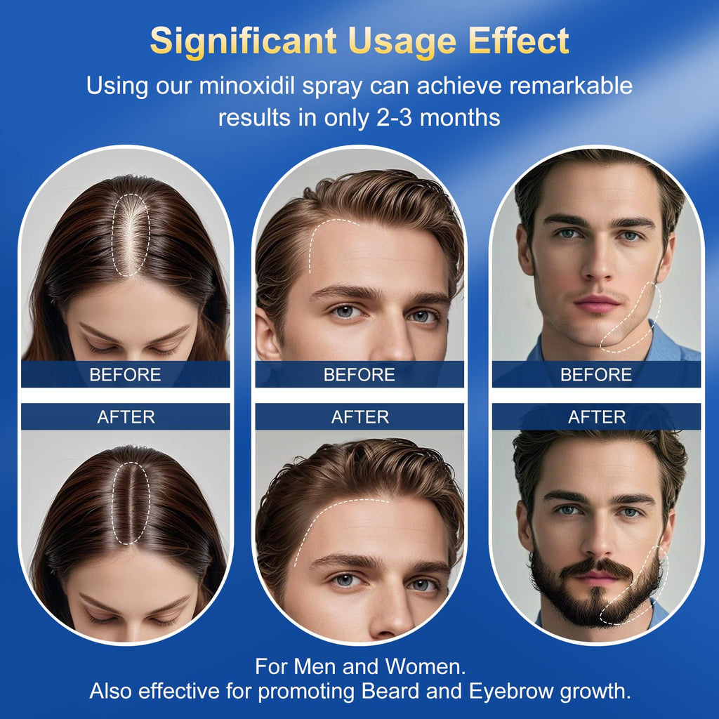 Kweqdsd 5% Minoxidil Spray for Men – 6 Pack, 21oz, Biotin Infused Hair & Beard Growth