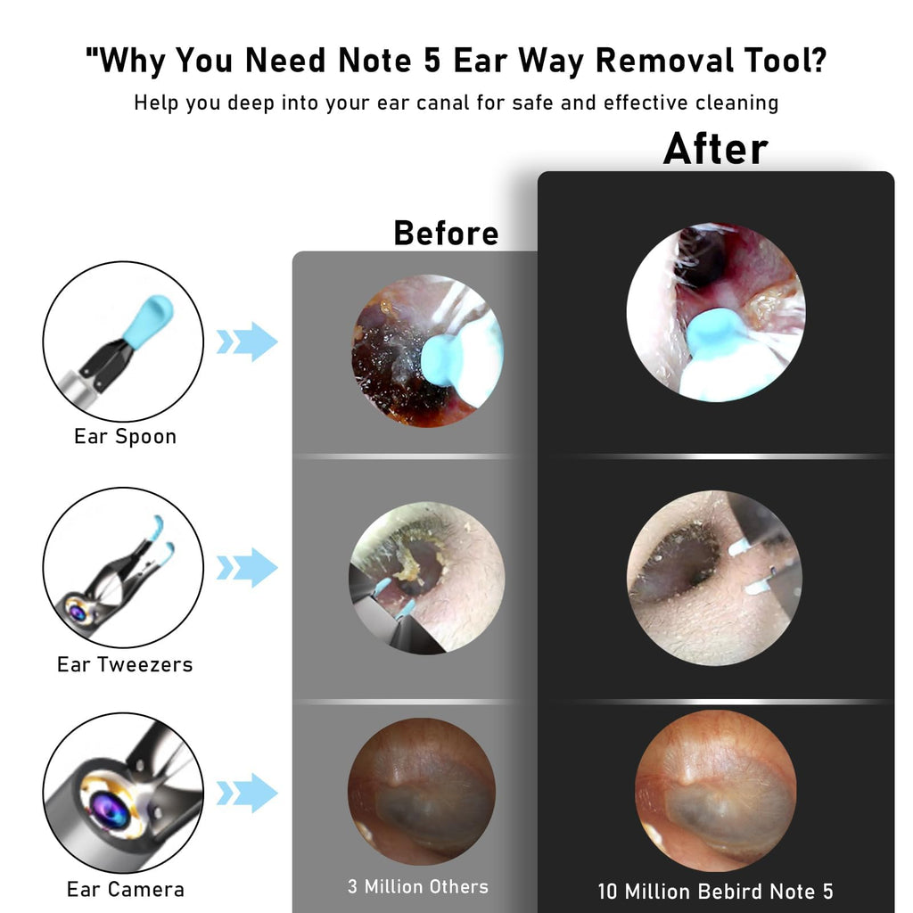KWYBOW Note5 Ear Wax Removal Kit with Camera – 10MP Otoscope & Real-Time Video