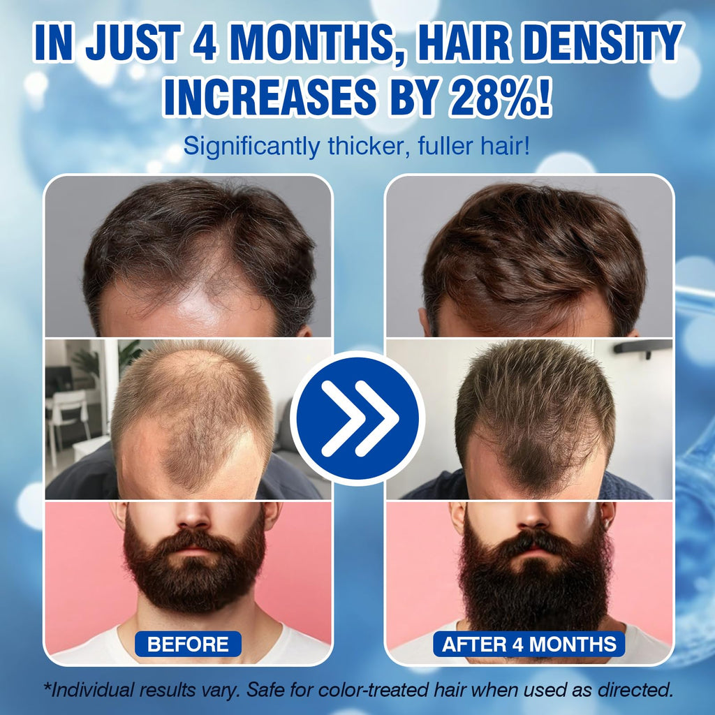 LIPEND 5% Minoxidil for Men Hair Growth Spray — Beards & Scalp, 3 x 2oz