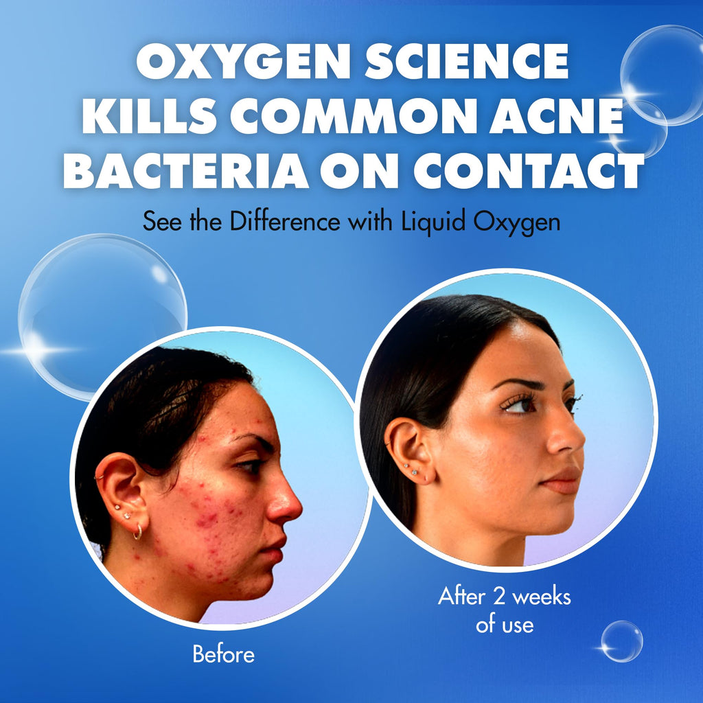 Liquid Oxygen Acne System – Oxygen-Infused 3-Step Acne Treatment for Clearer Skin