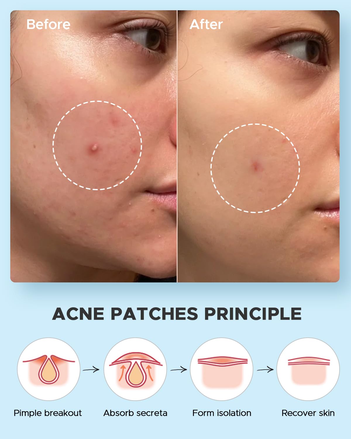 LitBear Acne Pimple Patches – Day & Night, 4 Sizes, 588 Dots