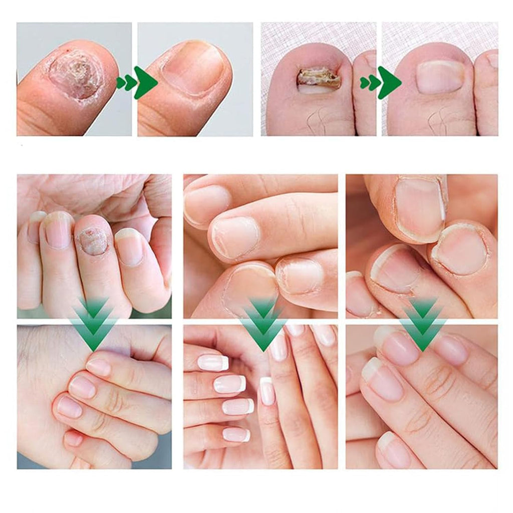 Lmoy 2PCS Nail Repair Gel & Nail Growth Cream – Multi-Purpose Nail Care