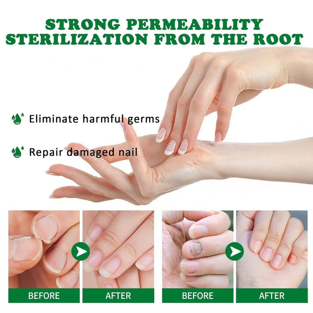 Lmoy 2PCS Nail Repair Gel & Nail Growth Cream – Multi-Purpose Nail Care