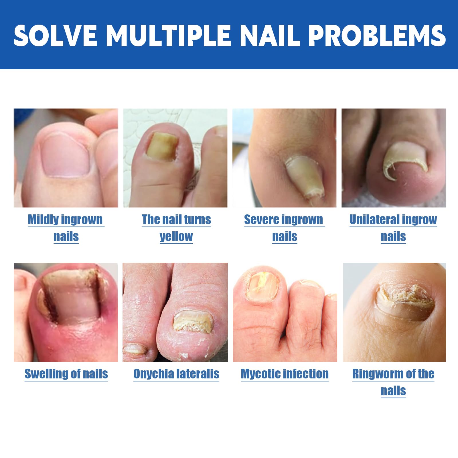 LYFXuGeMLM 20 Patches Fungal Nail Repair – Toenail Restoration, 8-Hour Intensive Treatment