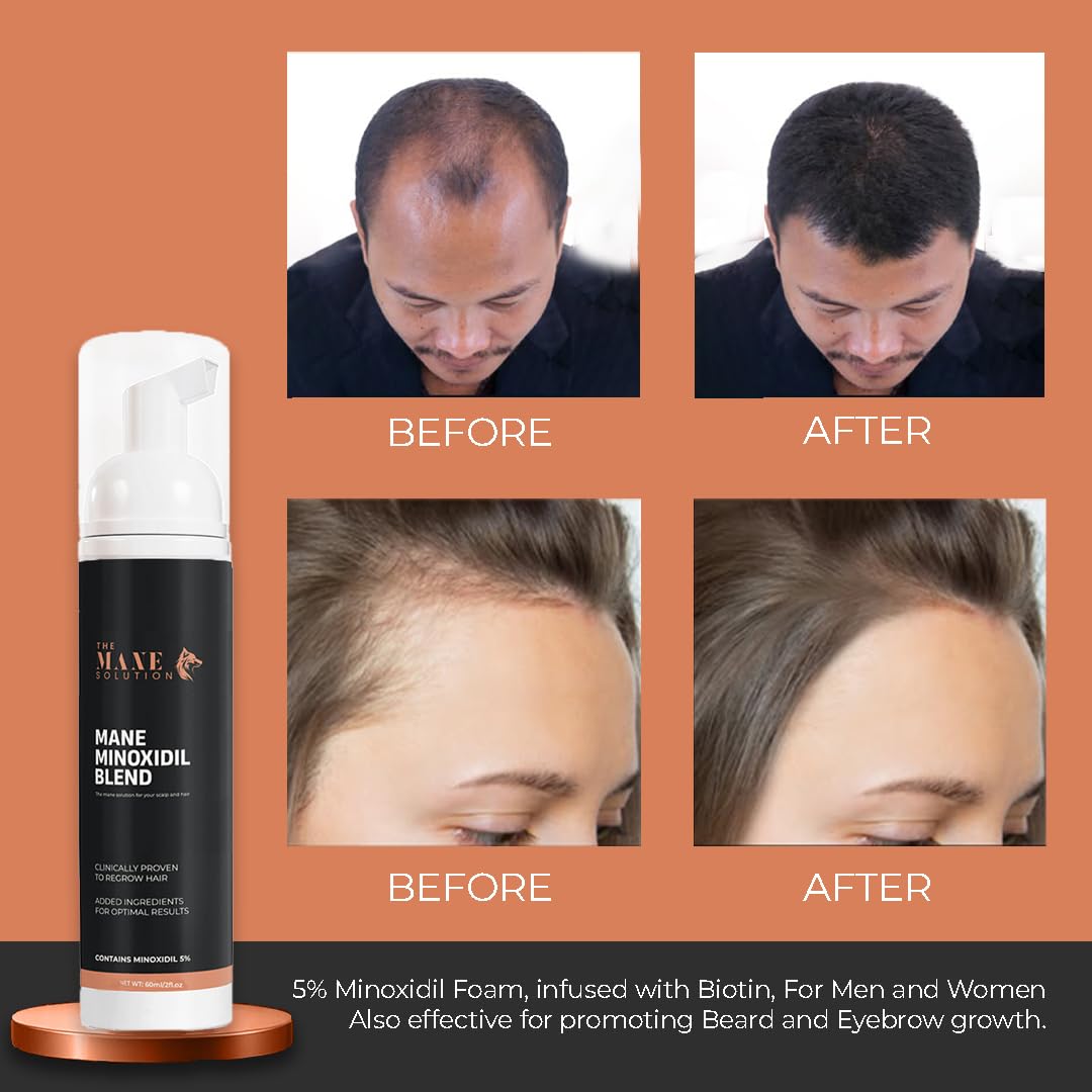 The Mane Minoxidil Blend Foam 5% — Hair Growth & Regrowth Solution | The Mane Solution