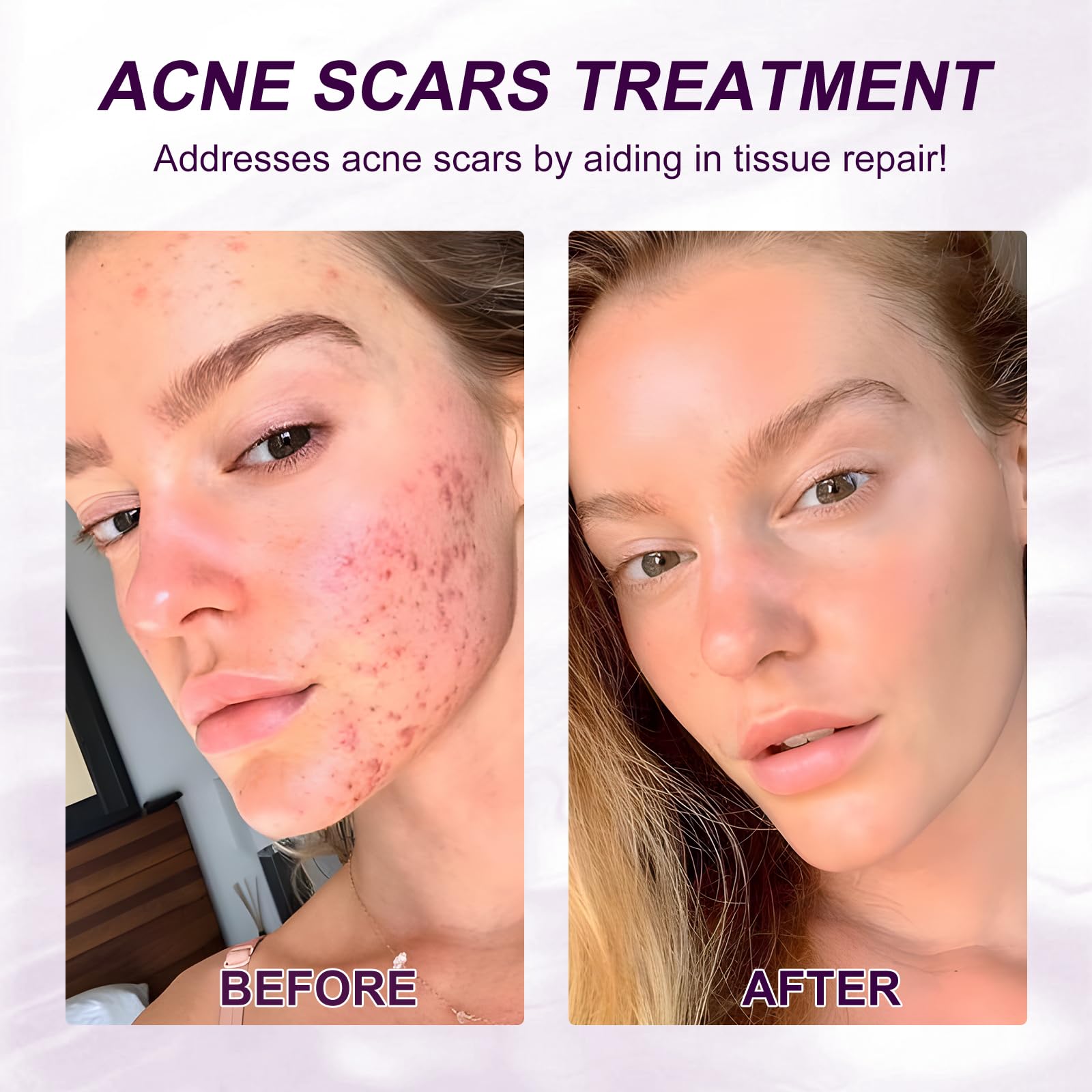 Marianp Hyaluronic Acid Serum with 10% Azelaic Acid – Hydration & Gentle Acne Support
