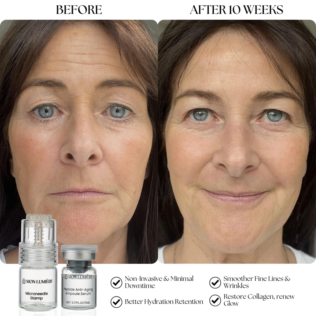Mon Lumière Micro-Infusion System – 0.25mm Gold Derma Stamp with PDRN & Peptides – At-Home Facial Starter Kit