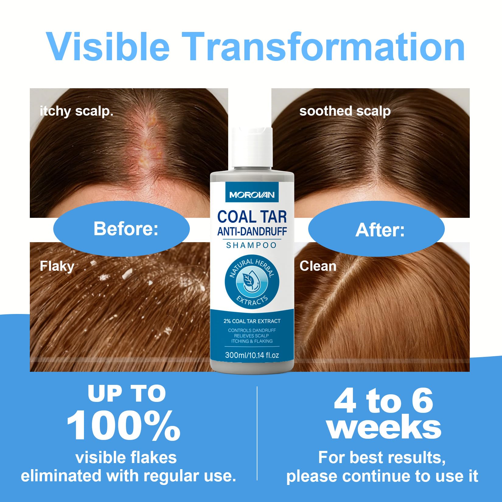 Morovan Coal Tar Shampoo 2%: Severe Dandruff & Itchy Scalp