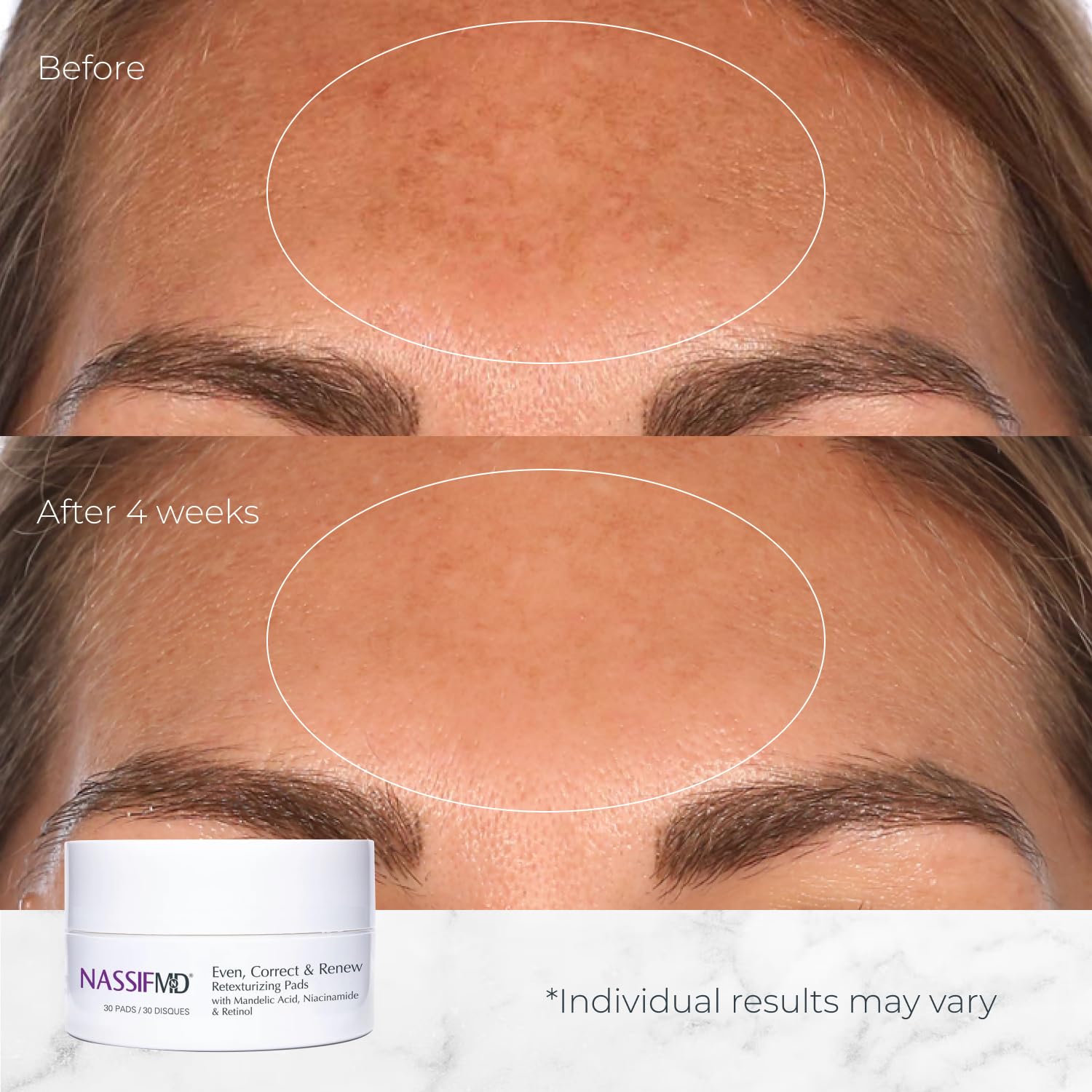 NassifMD Even, Correct & Renew Retexturizing Pads | Facial Peel for Texture & Tone