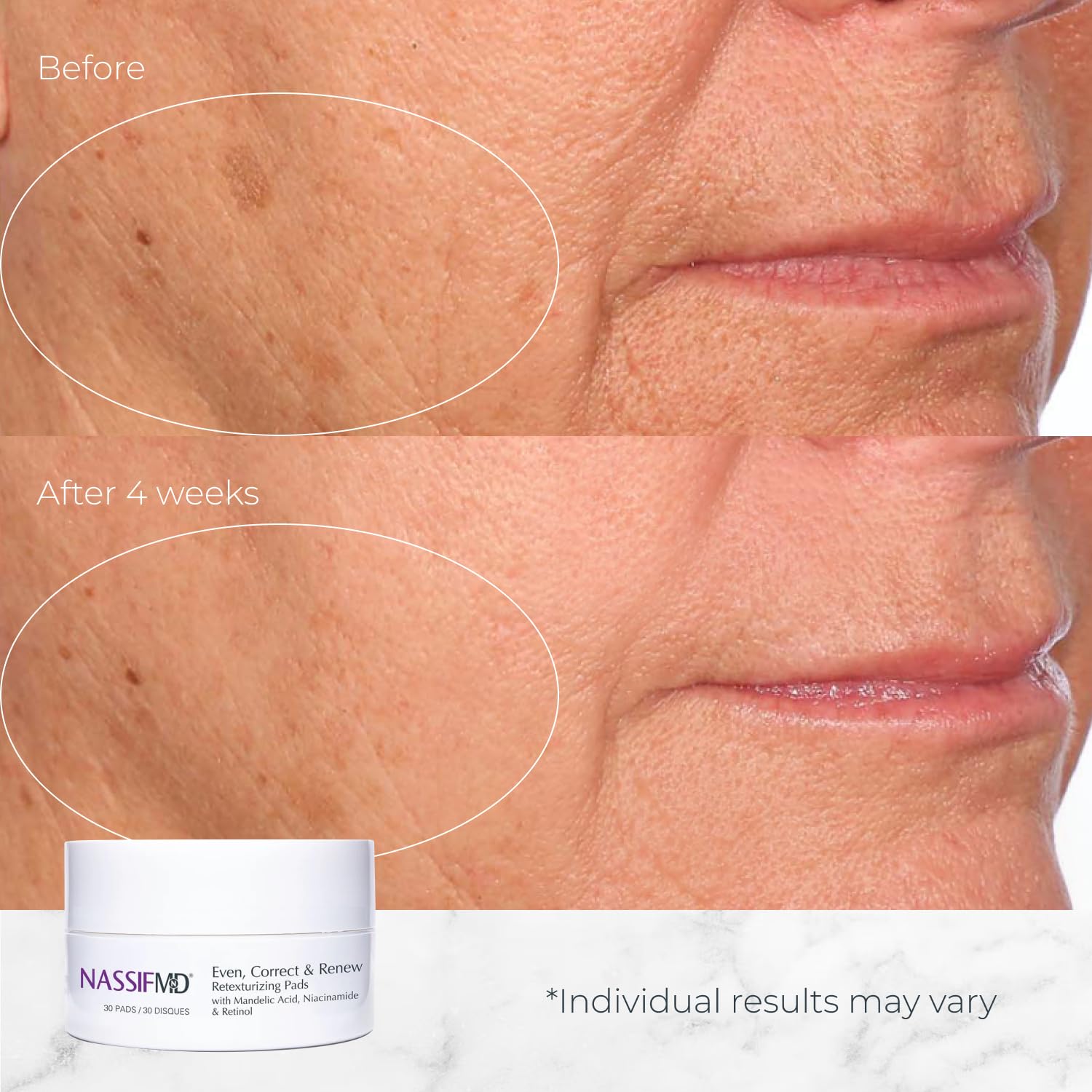 NassifMD Even, Correct & Renew Retexturizing Pads | Facial Peel for Texture & Tone