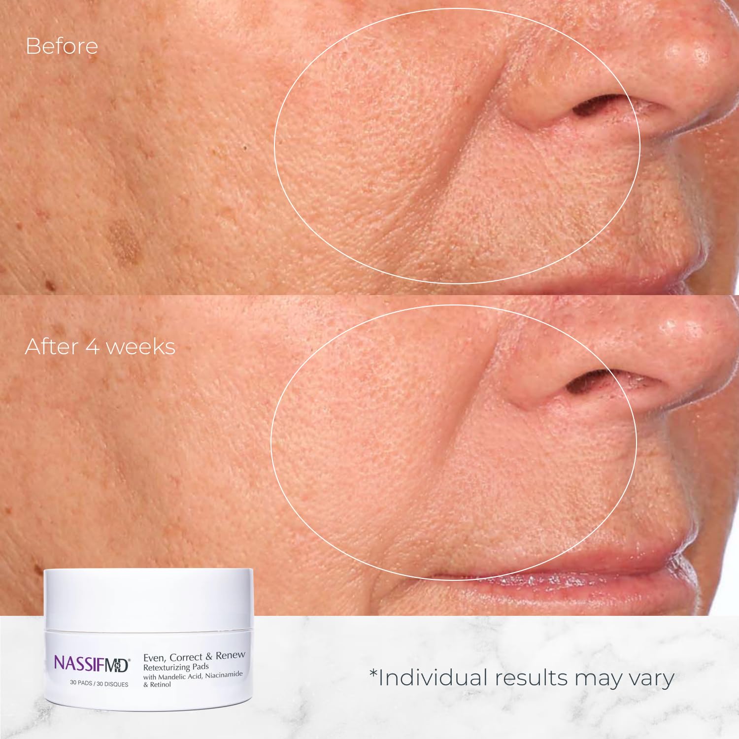 NassifMD Even, Correct & Renew Retexturizing Pads | Facial Peel for Texture & Tone