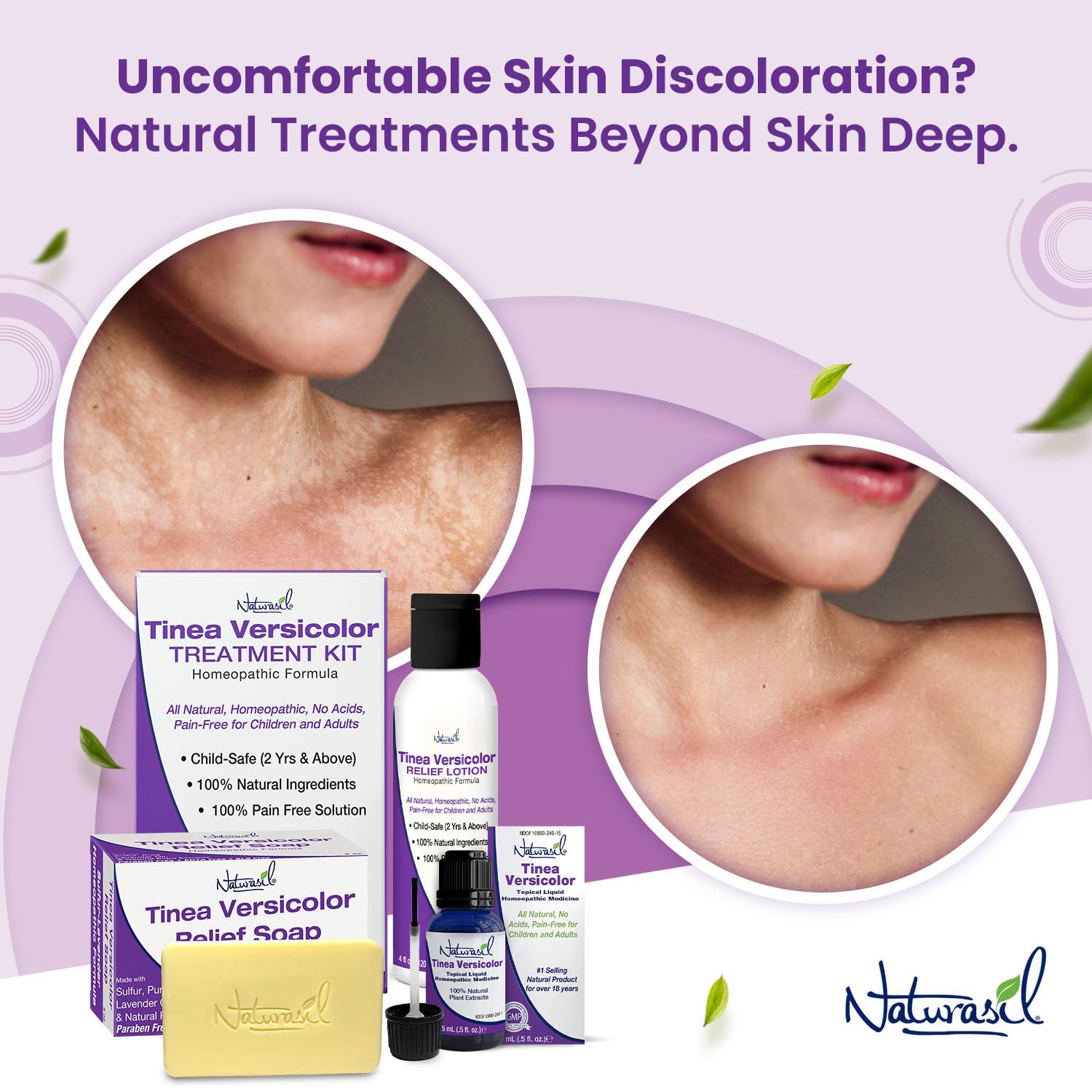 Naturasil Tinea Versicolor Treatment Soap (2-Pack) – Max-Strength 5oz Bars