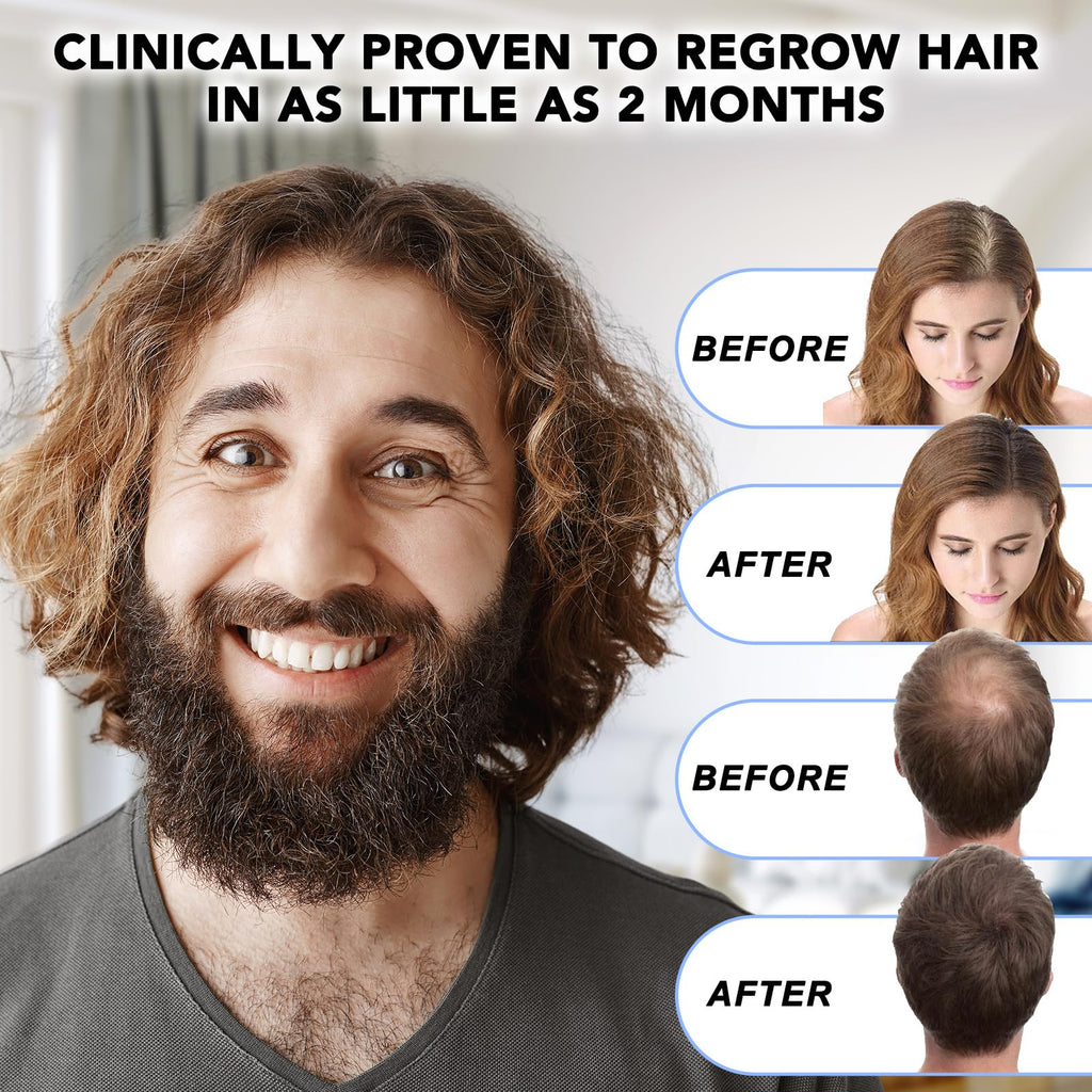 Nature Ziran Minoxidil 5% Extra Strength Hair Regrowth for Men & Women – Dropper Applicator Included