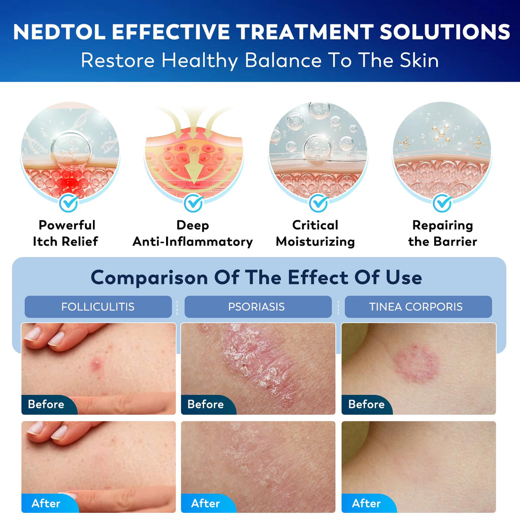 Nedtol Folliculitis Treatment Cream – 7X Fast-Acting Antibacterial Ointment | 120g